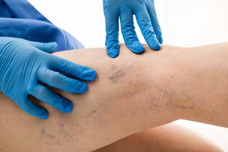 How to Treat Bad Veins with a Medical Laser